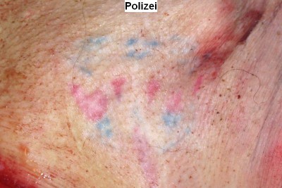 entferntes Tatoo.jpg